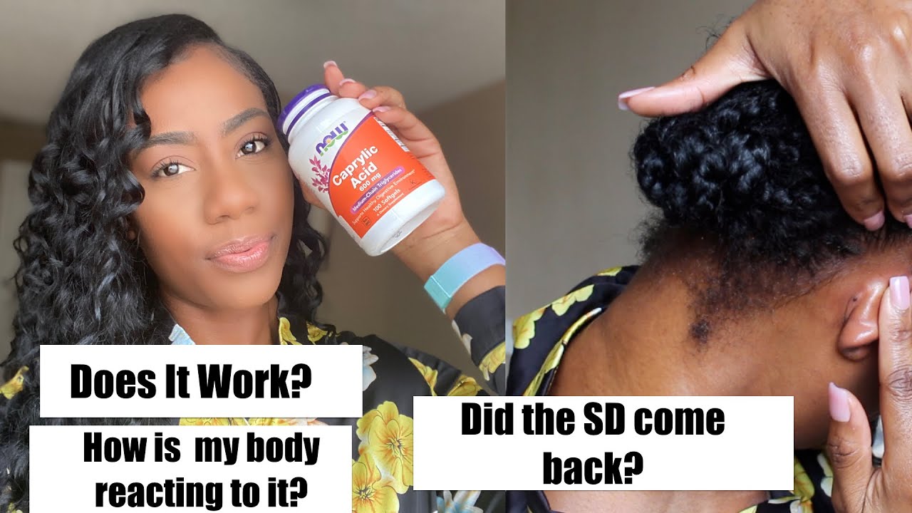 Update On the Caprylic Acid| Does it really help on getting rid of Seborrheic Dermatitis? 🥴