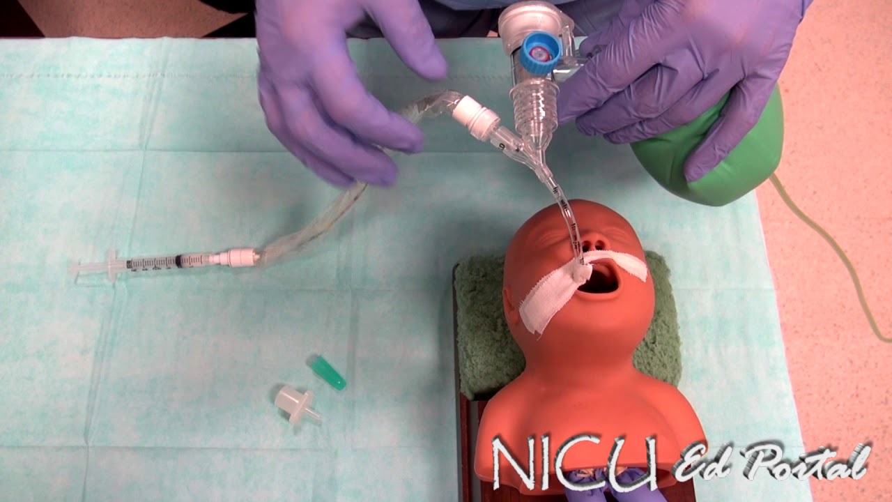 Surfactant administration in a preterm infant