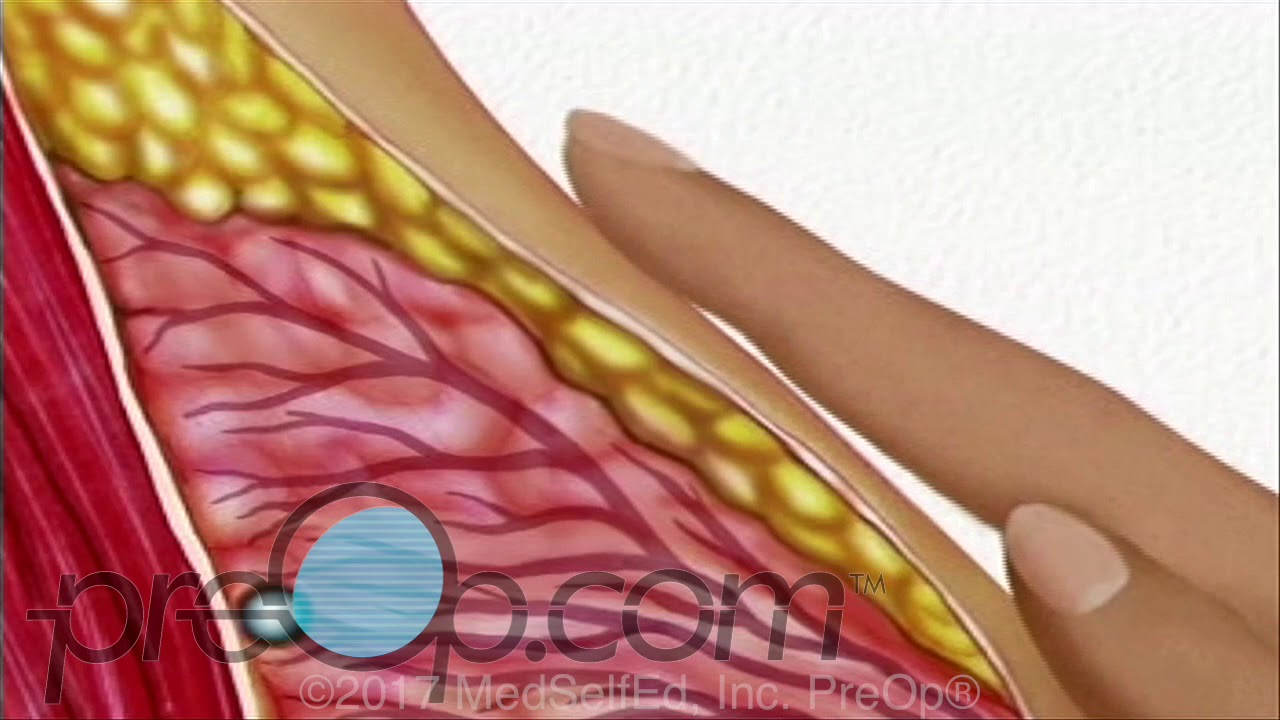 Breast Needle Biopsy Procedure &bull; Patient Education Surgery