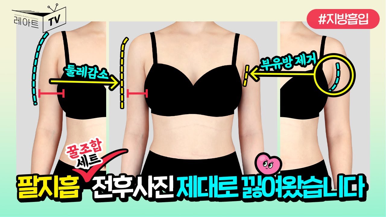 [팔지방흡입] 전후사진 제대로 낋여왔습니다🙌 feat.부유방, 겨드랑이, 견갑 [레아트성형외과]