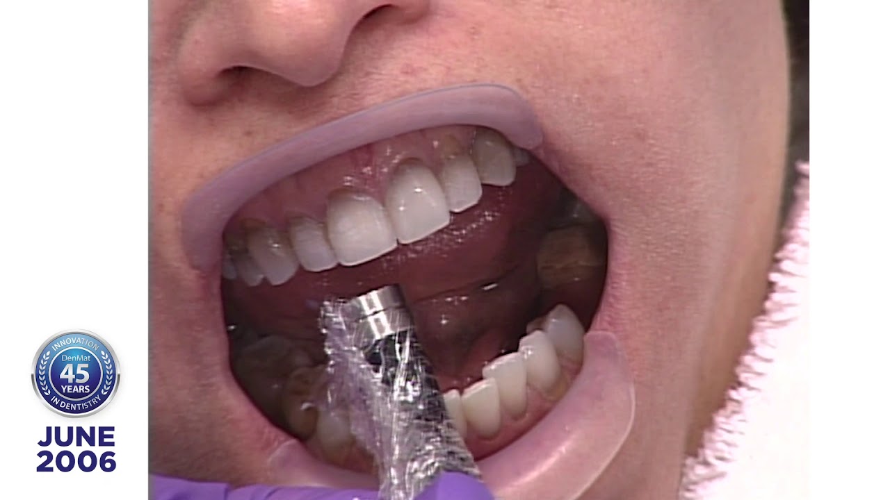 Dr. Robert Ibsen Presents Joanne M., a Lumineers® Clinical Case Presentation: 2006