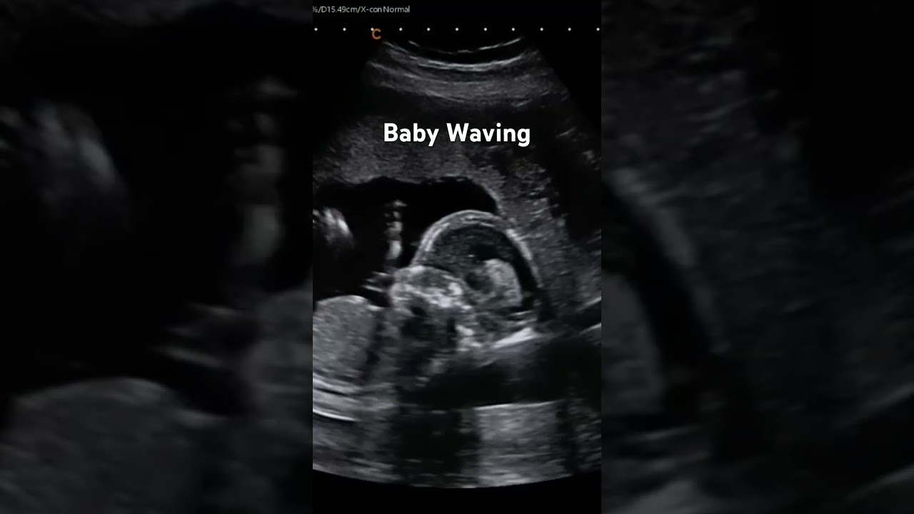 Baby Waving 🥰 #jerbearimaging #18weekspregnant #wave #pregnant #sono