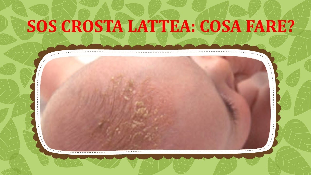 SOS Crosta Lattea nel Neonato