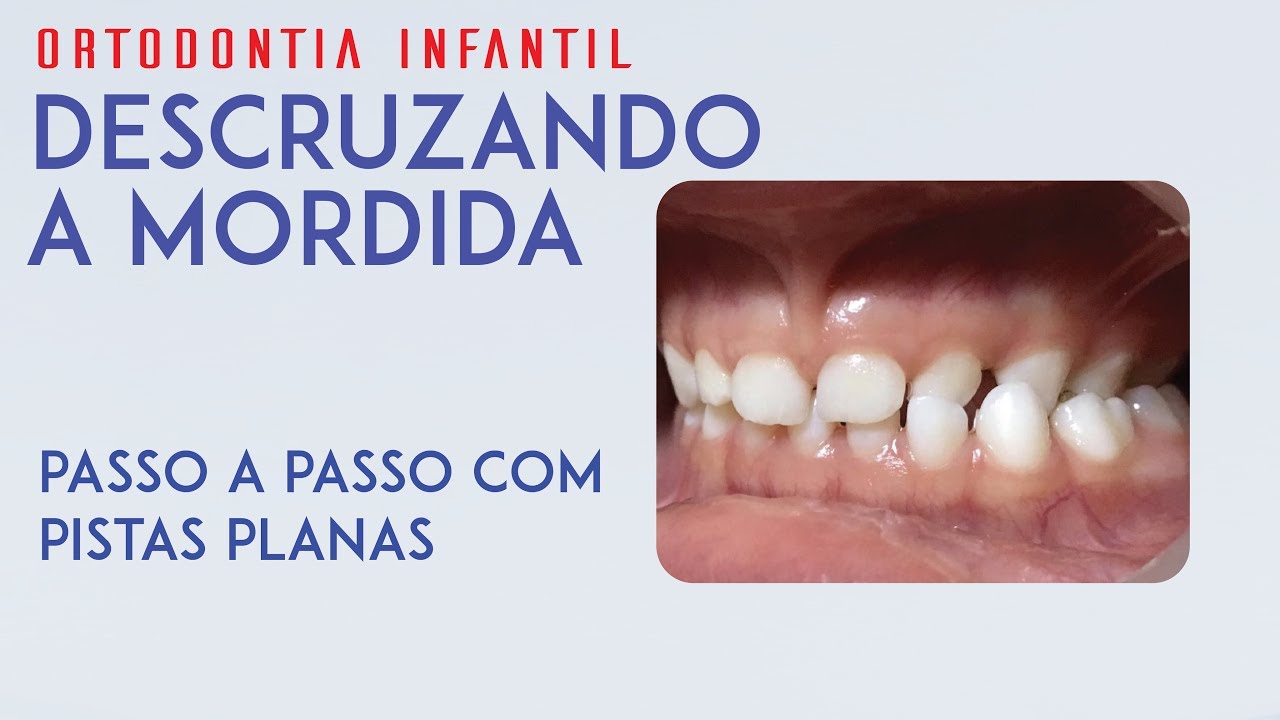 Dra Paulene Cardoso - Descruzando a mordida com pista plana - Passo a passo