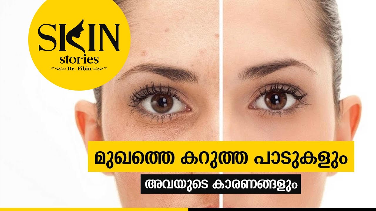 മുഖത്തെ കറുത്തപാടുകളും അവയുടെ കാരണങ്ങളും | Black spots on face | Dr. Fibin | Skin Stories #19