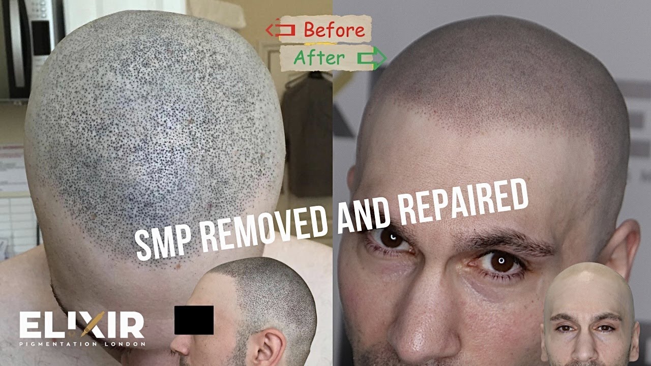 SMP removed and repaired (my journey)