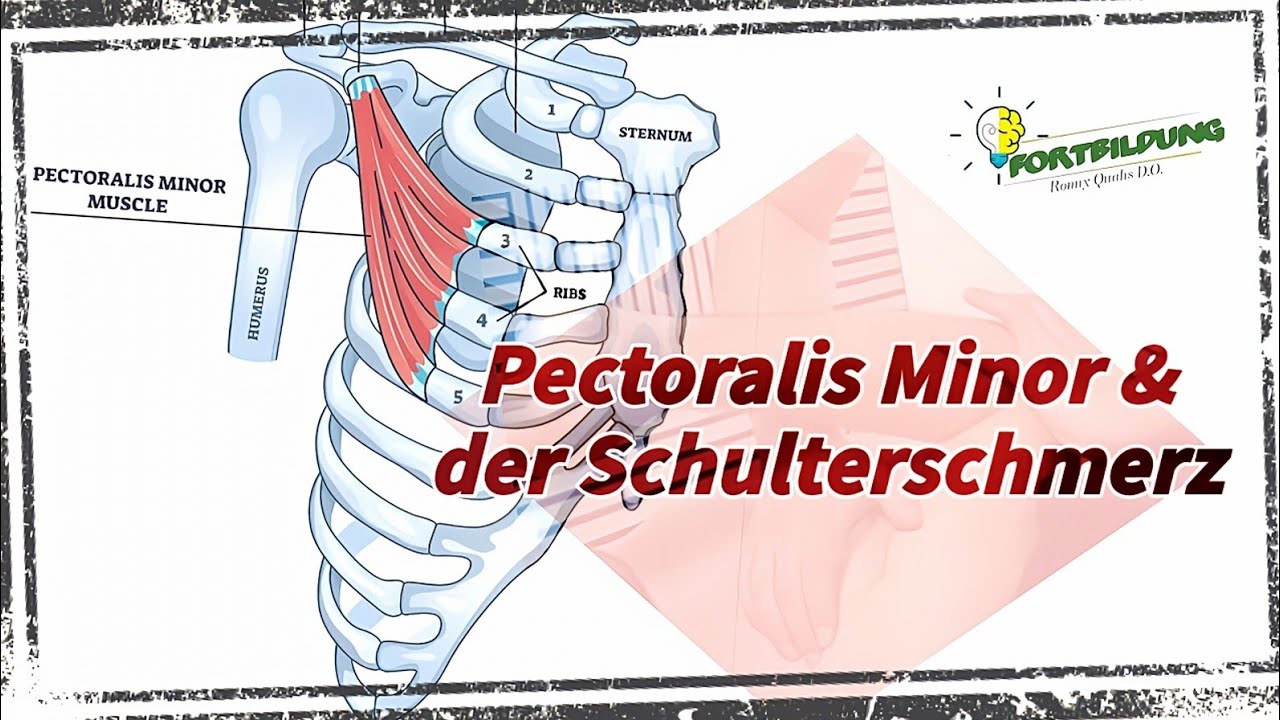 Osteopathische Medizin | Die Schulter Teil 1- Der M. pectoralis minor - Ursache für Schulterschmerz