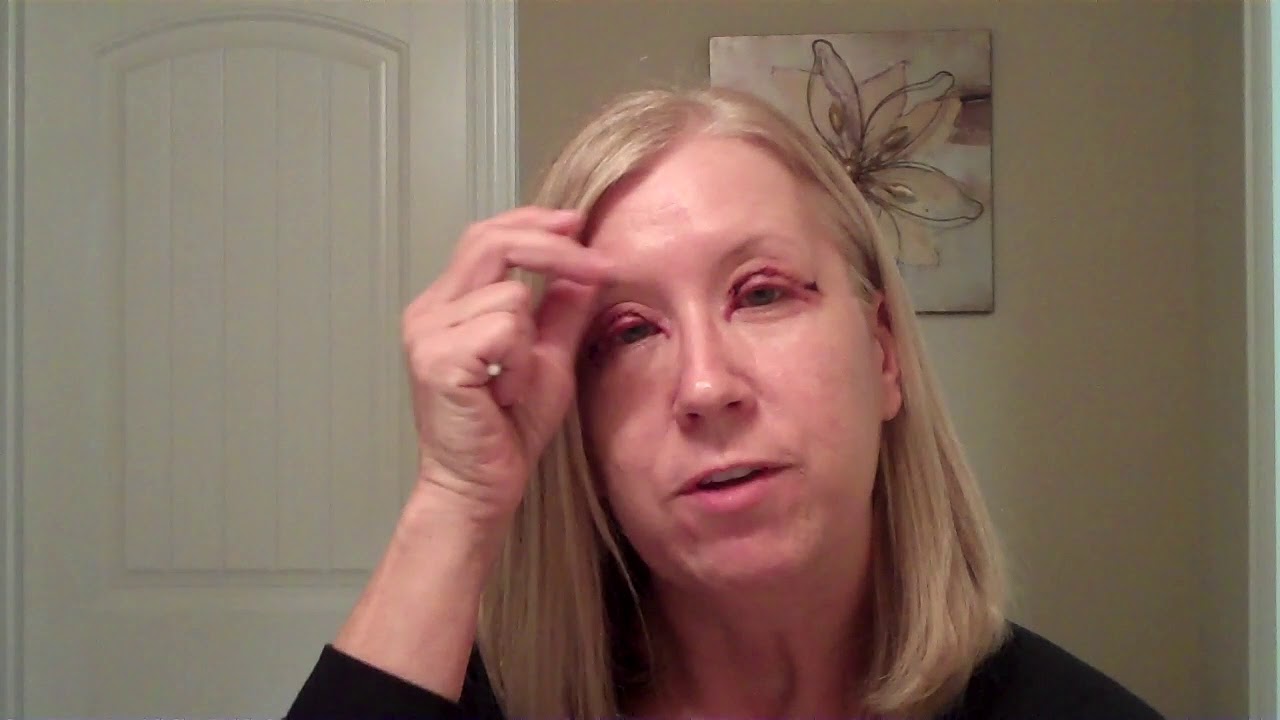 Dallas Upper Eyelid Blepharoplasty Recovery with Dr. Sam Lam