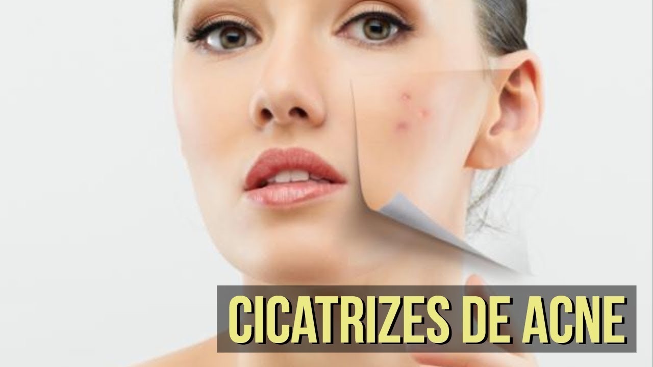 Acnes - Como tratar cada tipo?