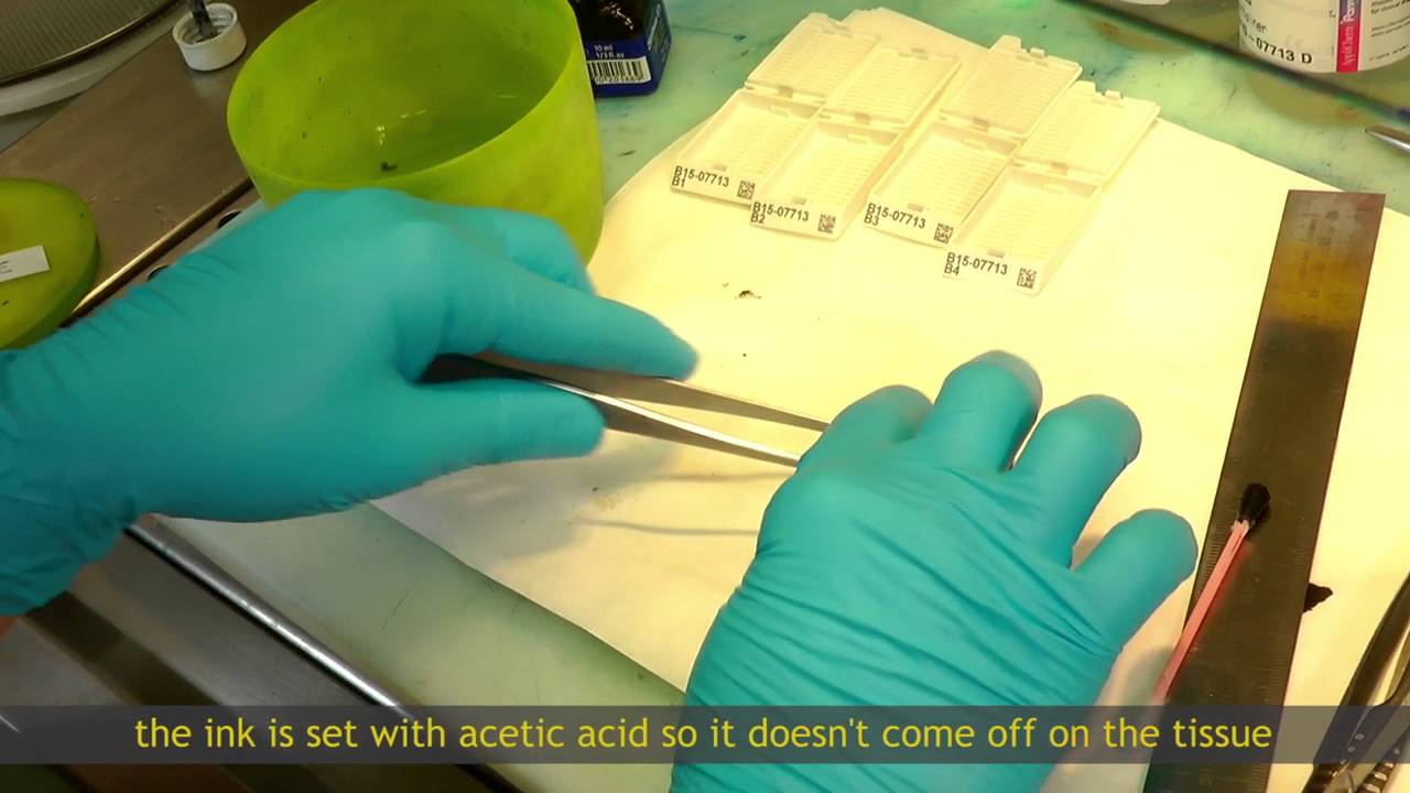 Management of colorectal cancer screening biopsies laboratory of anatomical pathology