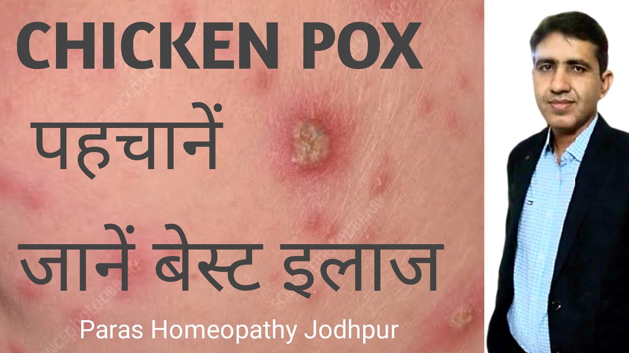 चिकन पॉक्स लक्षण ,कारण व् इलाज | Chicken Pox Homeopathic Medicine | Scars Removal |Dr.Ramdeo Lamoria