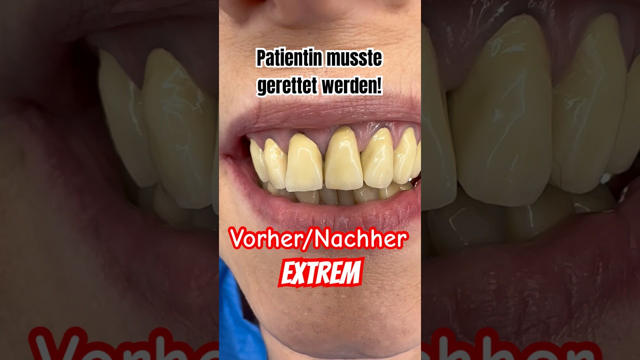Zahnkronen Vorher/Nachher - #zahnarzt #sch&ouml;nez&auml;hne #zahnersatz #zahnkrone