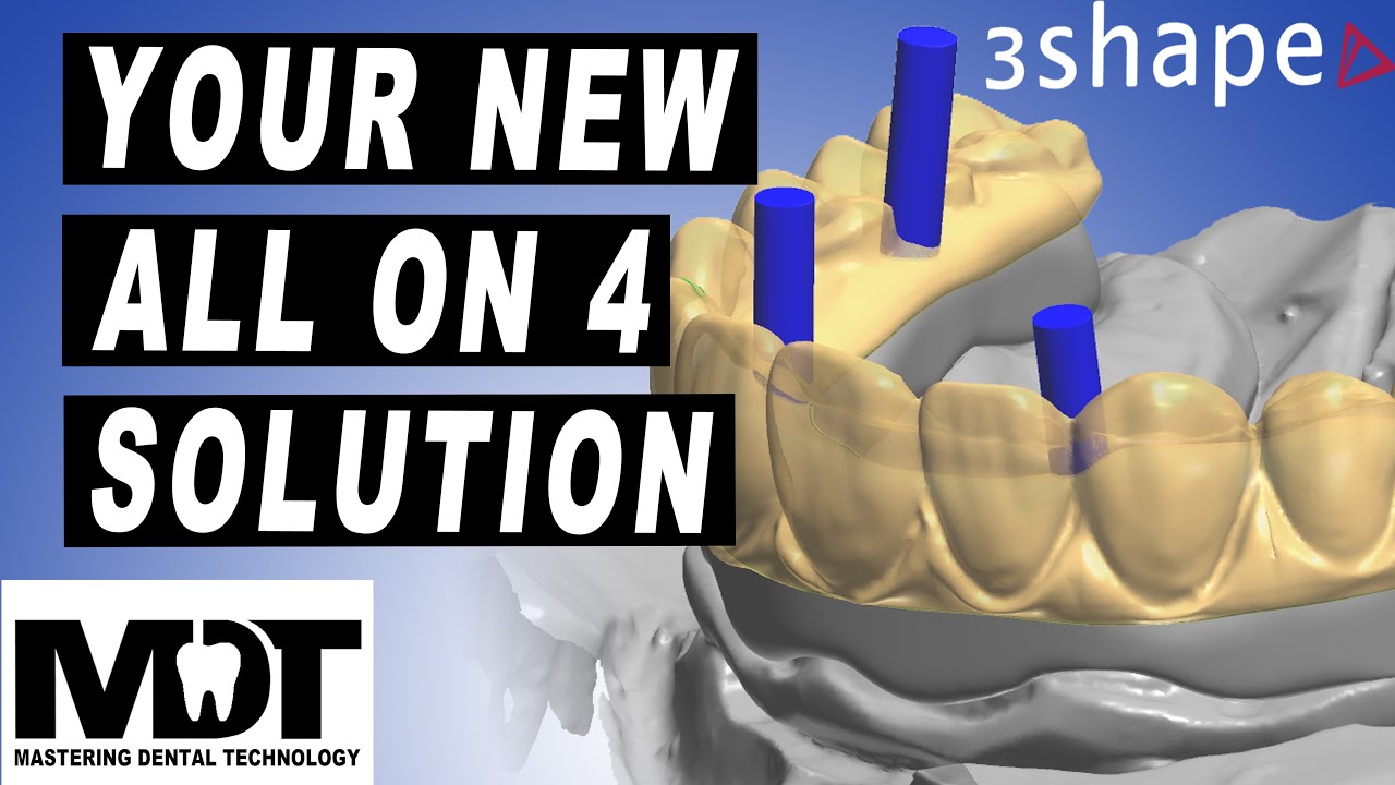 3Shape Crystal Ultra Design Tutorial [The All on 4 Implant Hybrid  Bar Solution]