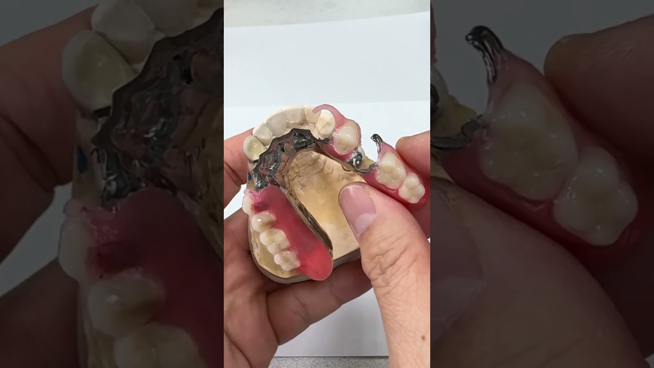 Great alternative solutions before placing the implants!