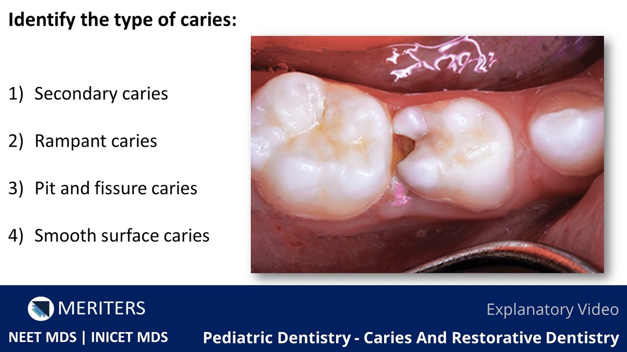 NEET MDS | INICET - Pediatric Dentistry | Explanatory Video