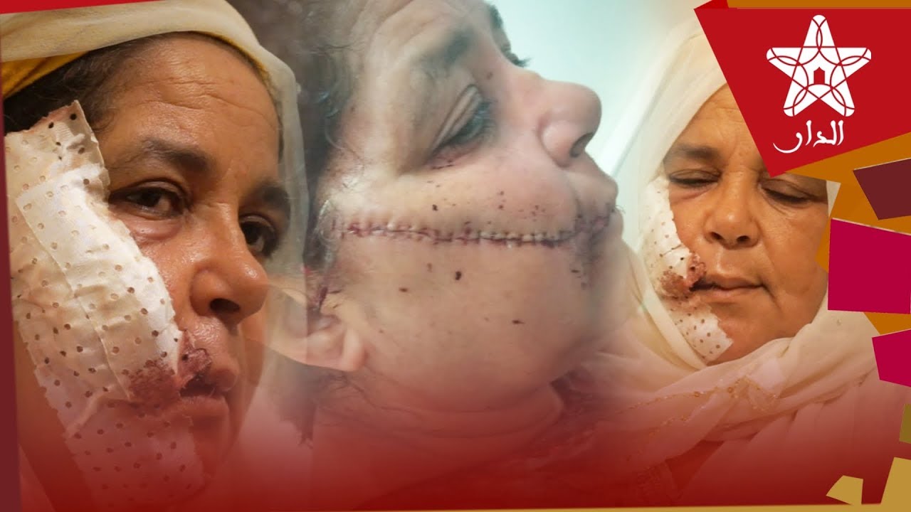 وتستمر ظاهرة التشرميل بحي مولاي رشيد بالدار البيضاء و الضحية هذه المرة امرأة مسنة