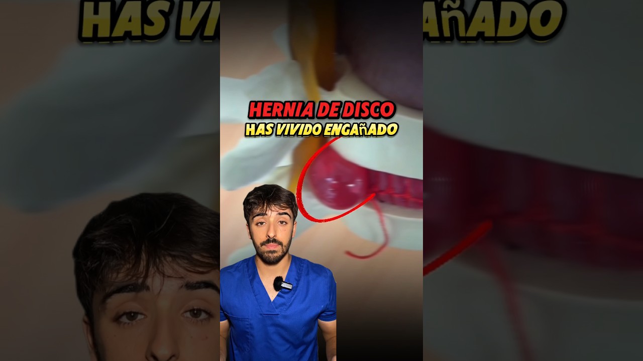 ❗️HERNIA DE DISCO❗️Toda la informaci&oacute;n en Instagram #dolor #espalda #vertebra #columna #ciatica