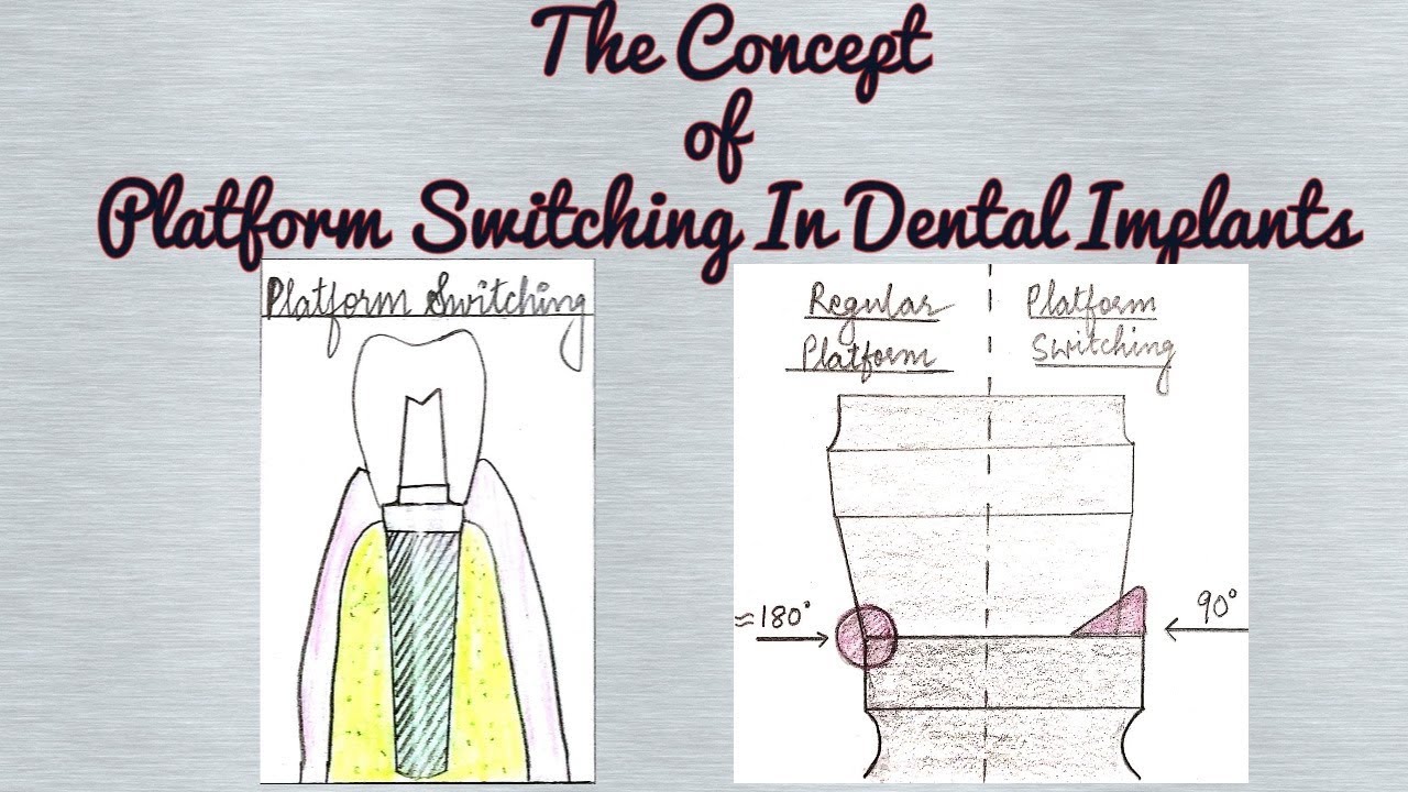 Platform Switching in Dental Implants/ Crestal Bone Loss around Dental Implants
