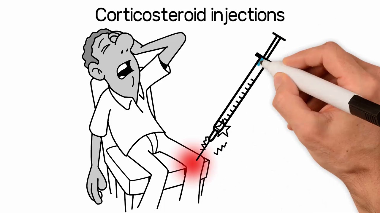 Knee Osteoarthritis Cortisone Steroid Injections; NYC Dr.