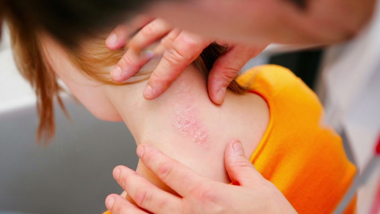 Deri Yolma Hastalığı Nedir ? Nasıl Tedavi Edilir ?