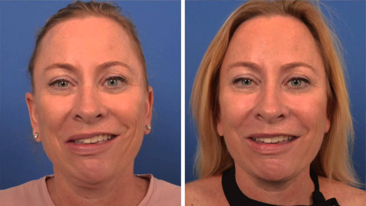Goals of Facial Reanimation Surgery | Facial Paralysis