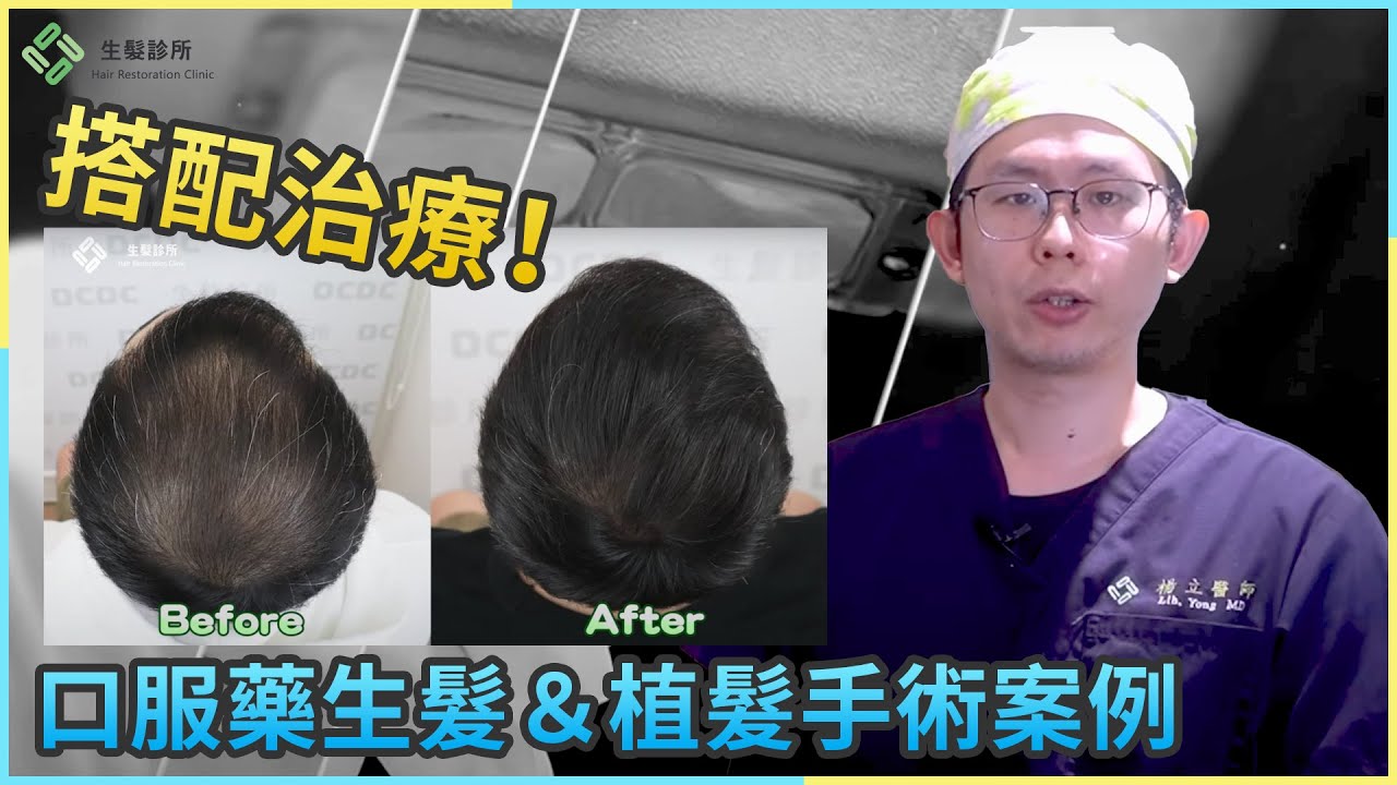 差很多！口服藥搭配治療改變這麼大｜植髮案例分享｜DCDC精準植髮