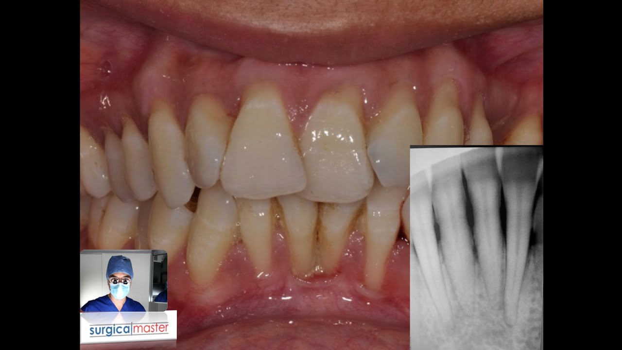 A complex Perio-Ortho case
