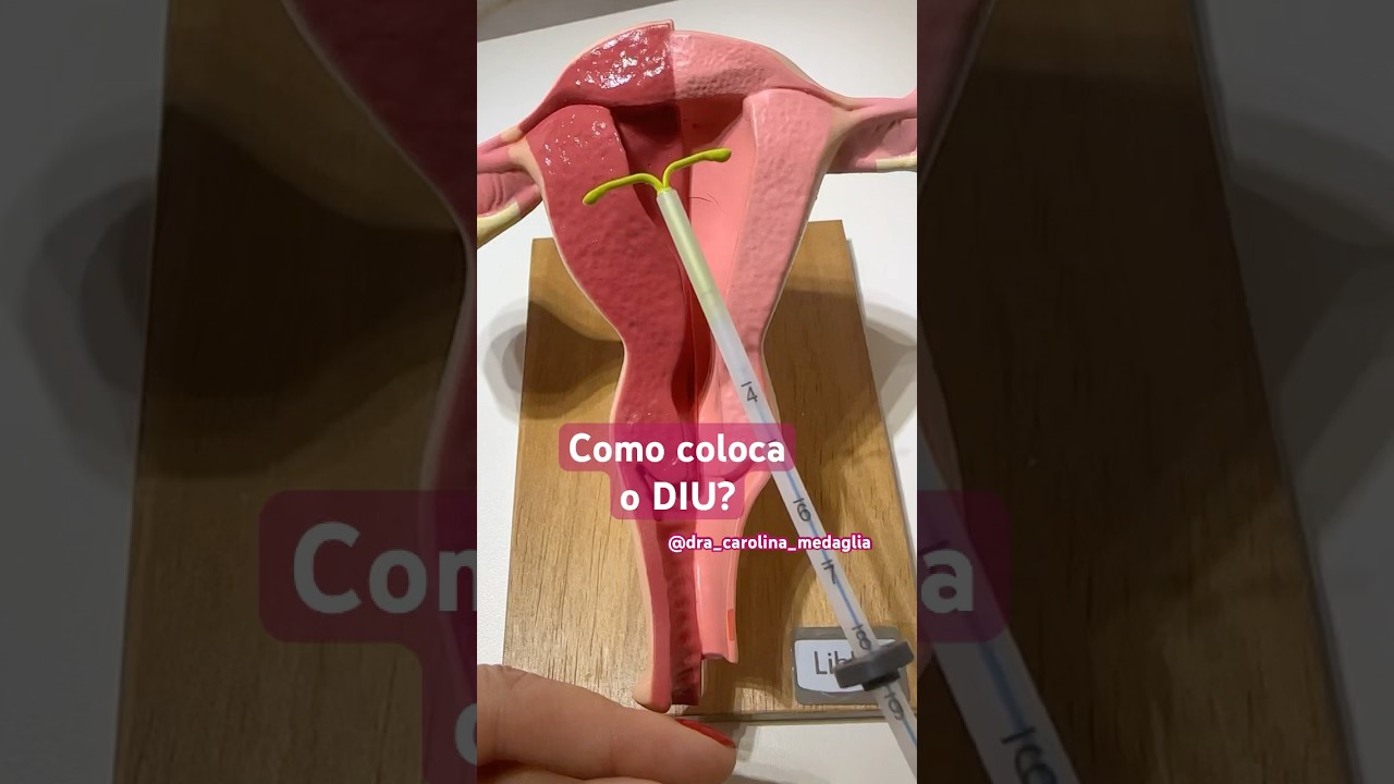 Como colocar o DIU?