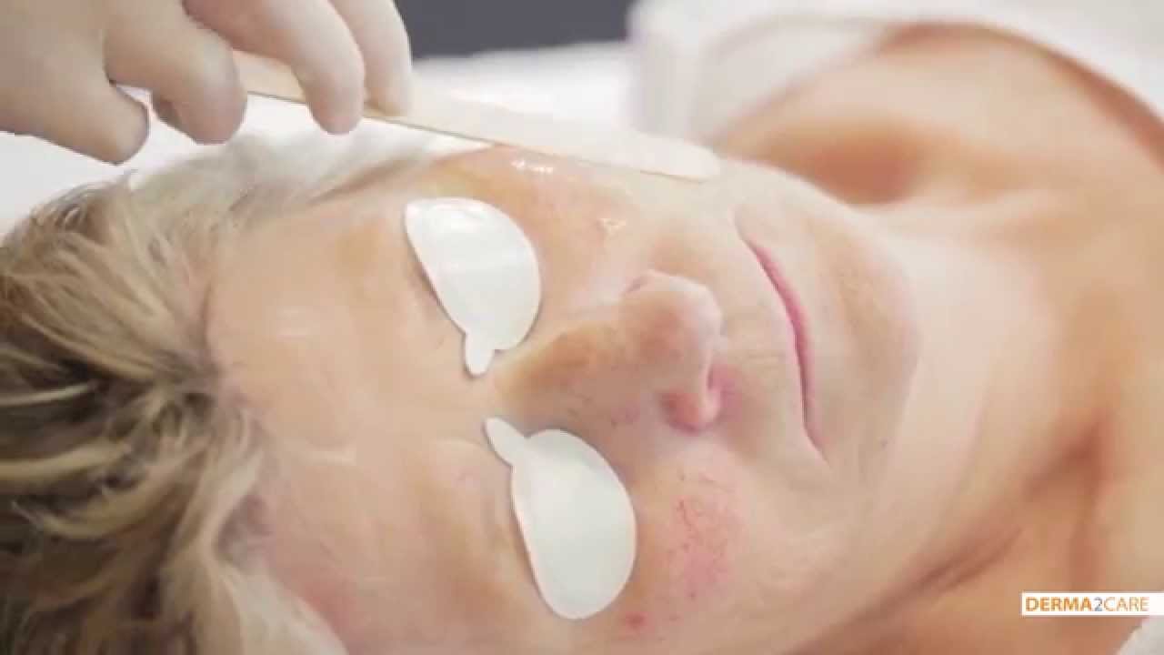 Couperose behandeling - De Huidkliniek