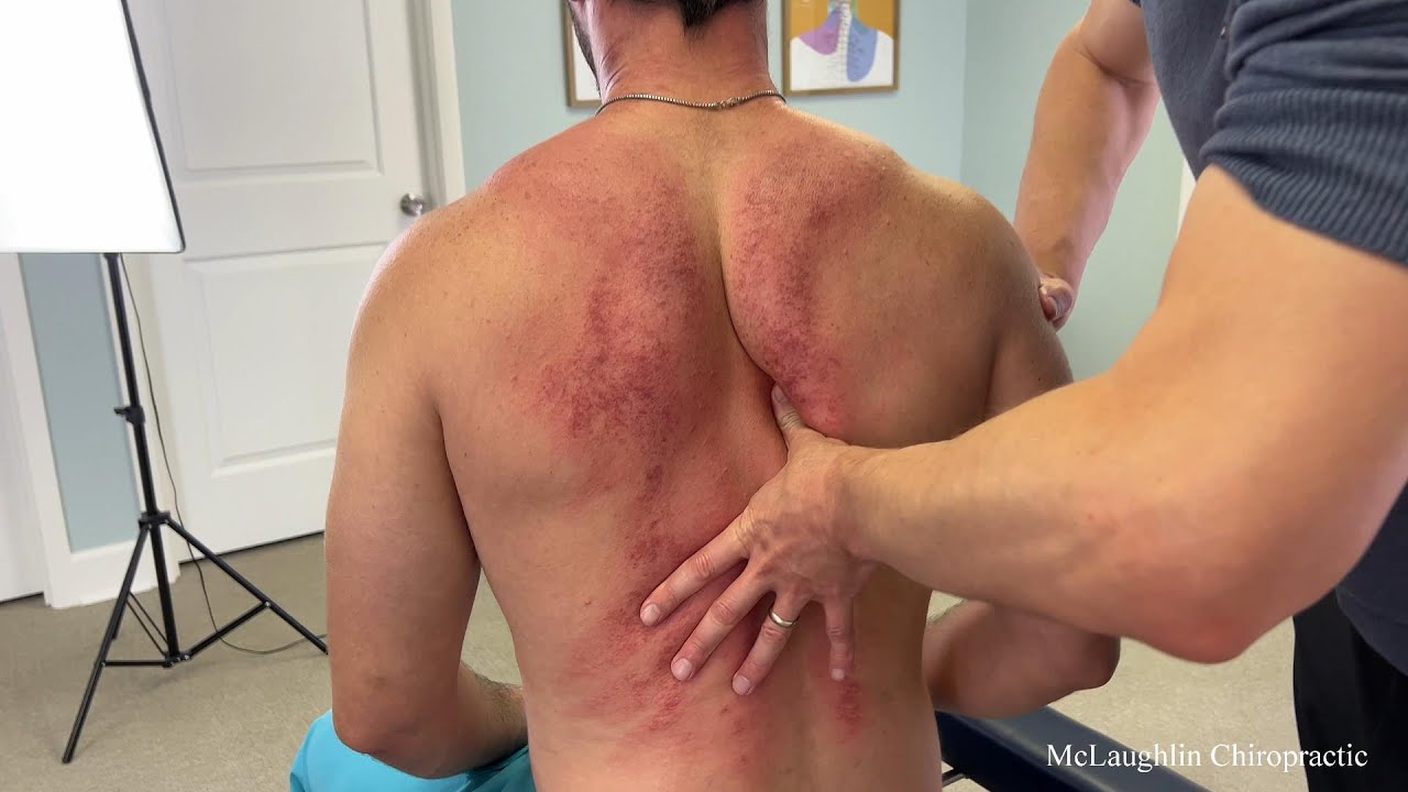 Painful *SCAPULA KNOTS* Released 😨 Helping A Frozen Neck Joint And A Back Rippled With KNOTS!