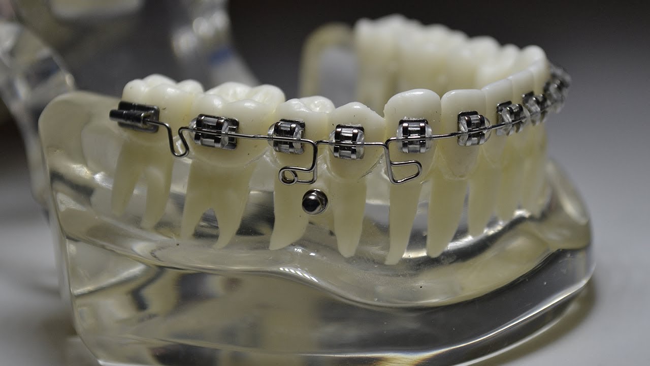 BOOTLOOP ORTODONTIA / BOOT LOOP ORTHODONTICS / BOOTLOOP ORTODONCIA