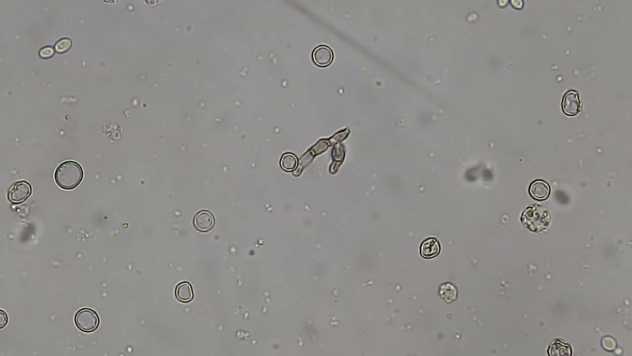 Septate fungal hyphae in KOH mount of Urine