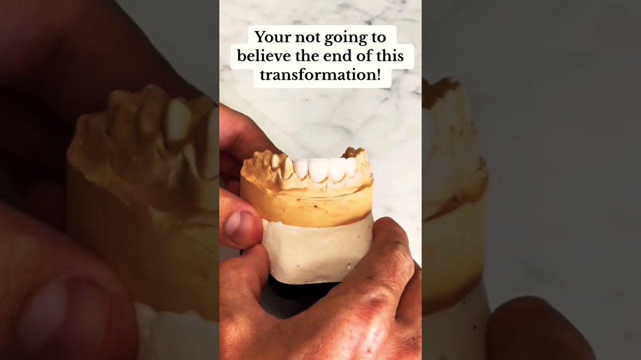 Peg laterals to a confident smile.