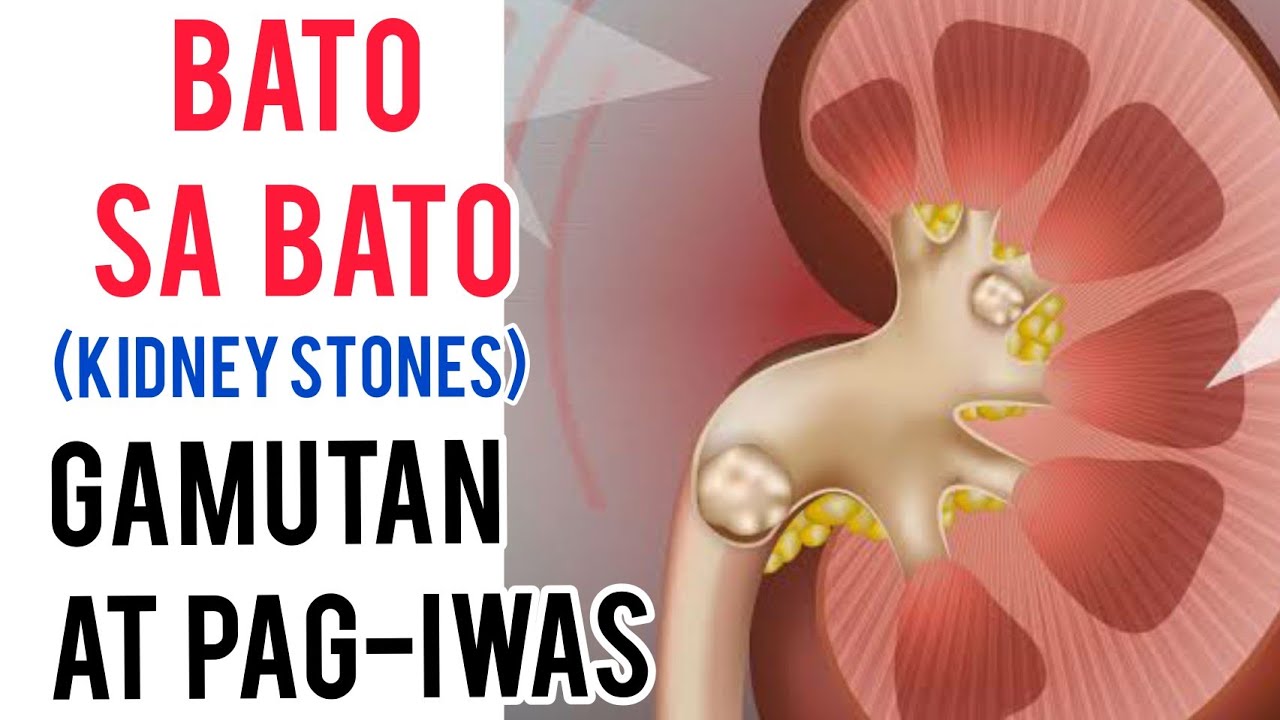 Sakit sa Kidney at Stones: Gamutan sa Bahay – by Doc Willie Ong #942