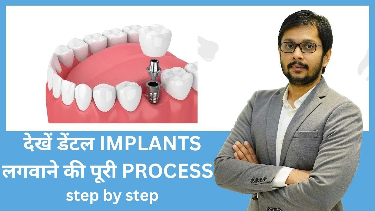 Exact procedure of dental implants.. Step by Step explained
