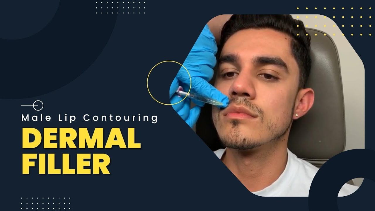 Male Lip Contouring | Dermal Filler | New York, NY | Dr. Jason Emer