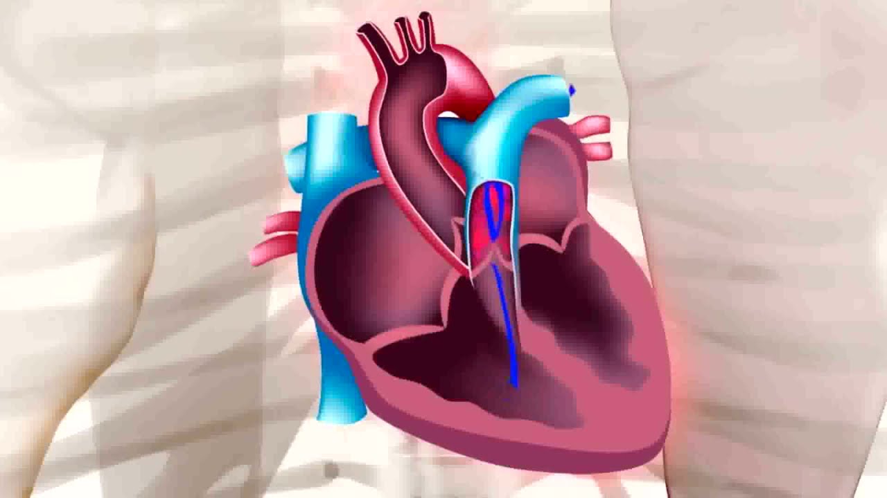 Insuficiencia y Estenosis Valvular