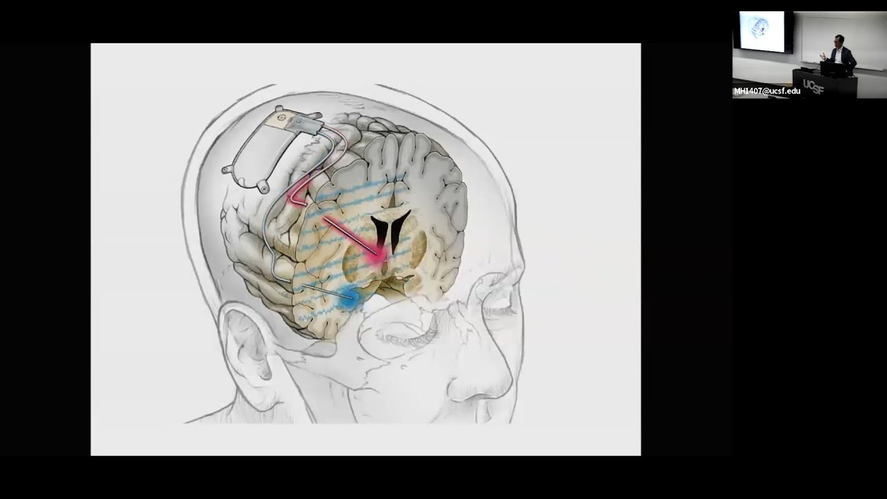 Neurotechnology for Glioma Modulation | Edward Chang, MD