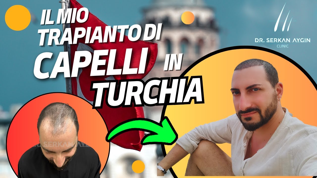 TUTTO ciò da Sapere sul TRAPIANTO DI CAPELLI IN TURCHIA  dal dott. SERKAN Aygin