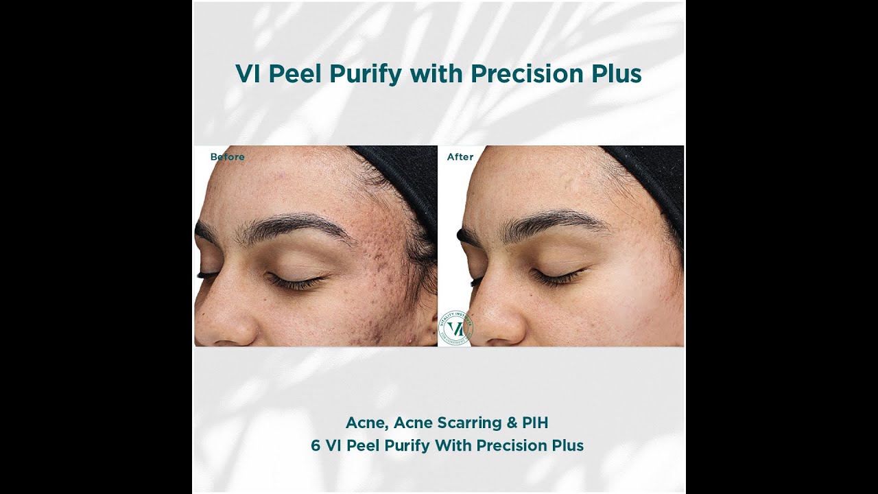 Best Chemical Peels in Dallas: VI Peel Precision Plus & Purify for Face at Sanjiva Medical Spa