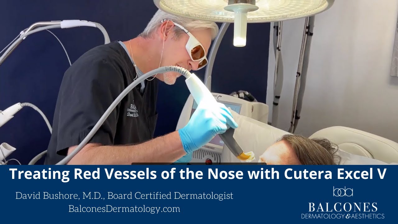 Treating Redness of the Nose with Cutera Excel V Plus Laser | David Bushore, MD. | Ph: 512-459-4869