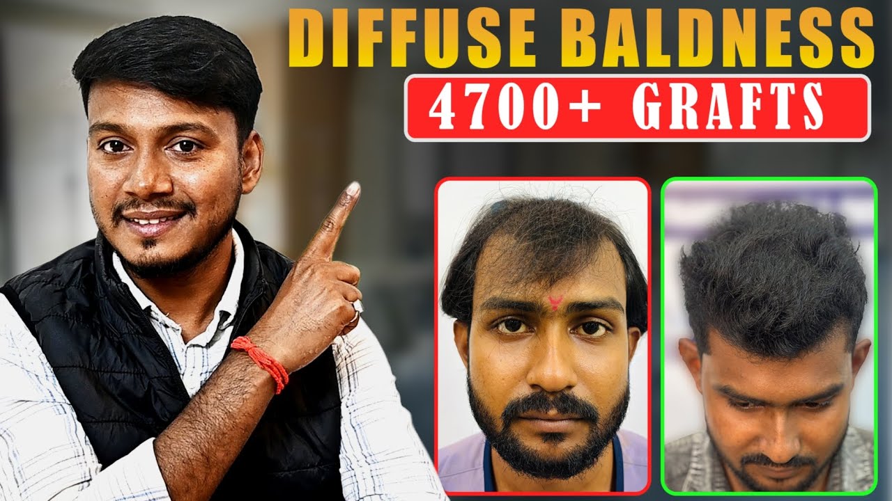 Hair Transplant In Kolkata Best রেজাল্ট কি আসলে  সত্যি!⚠️ #Kolkata #Cost