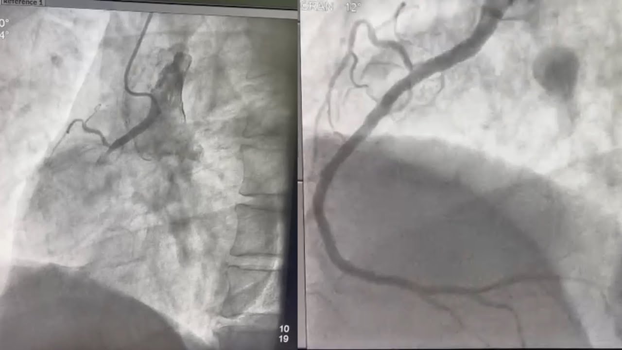 PTCA in high posterior origin RCA with AR-2 Catheter - Dr Md Faizuddin