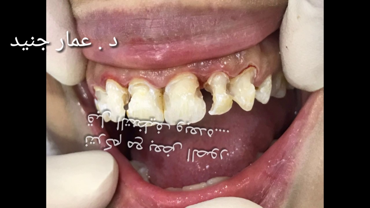 تجميل الأسنان المتهالكة وترميمها بعد التقويم