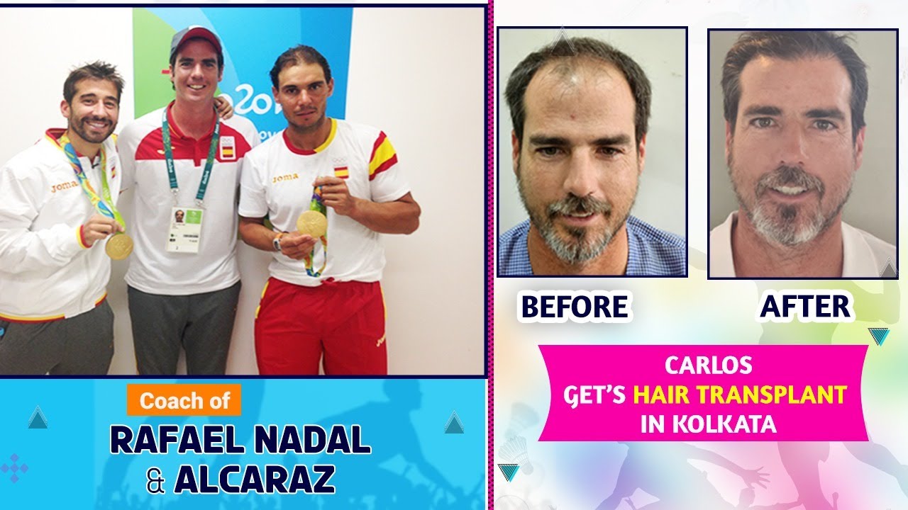 FUE Hair Transplant in Kolkata | Best doctor for FUE hair transplant in Kolkata | Best FUE in Spain