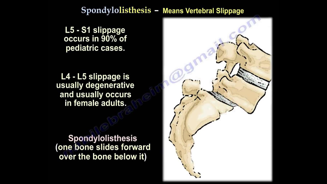 Spondylolysis,Spondylolisthesis,Spondylitis&Spondylosis-EverythingYou Need To Know-Dr.Nabil Ebraheim