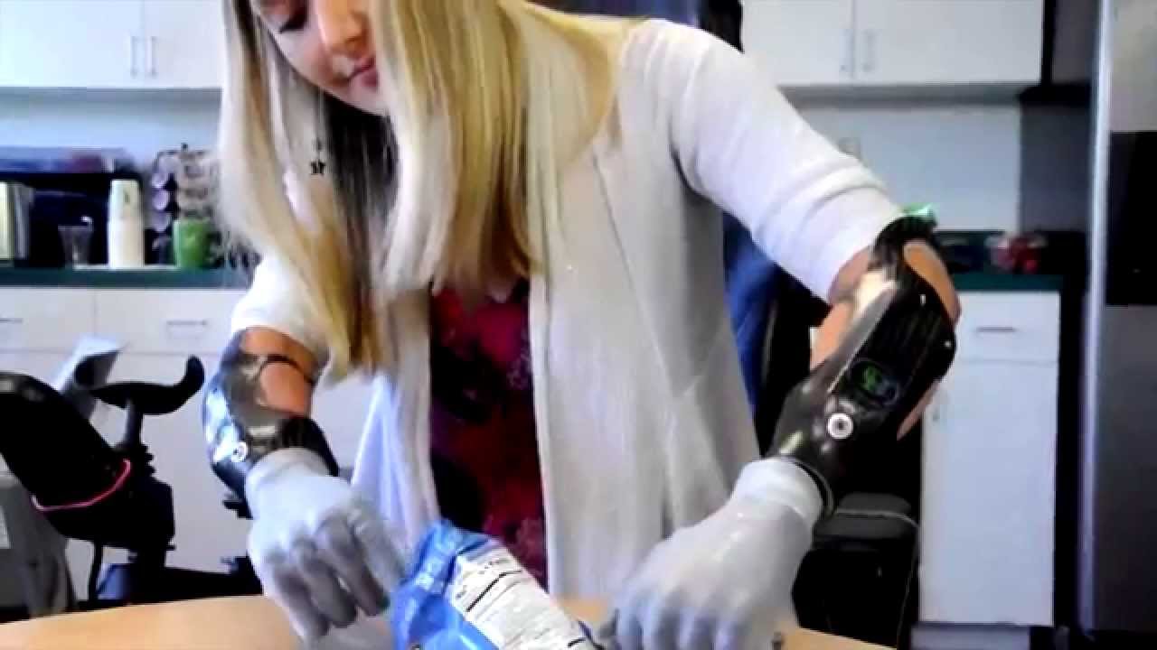 Aimee Copeland Amputee Gets biodesigns' HiFi Prosthetic Sockets