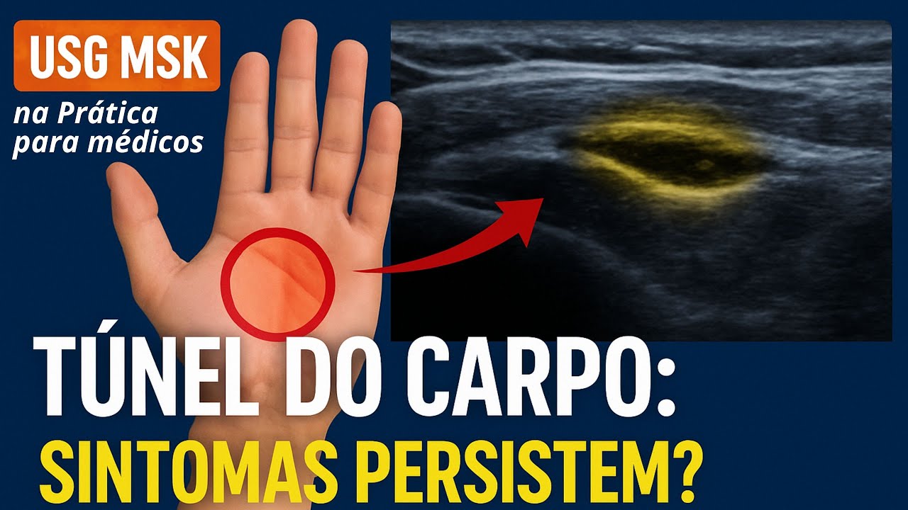 USG MSK Na Pr&aacute;tica: Avalia&ccedil;&atilde;o do t&uacute;nel do carpo em p&oacute;s-operat&oacute;rio com persist&ecirc;ncia dos sintomas