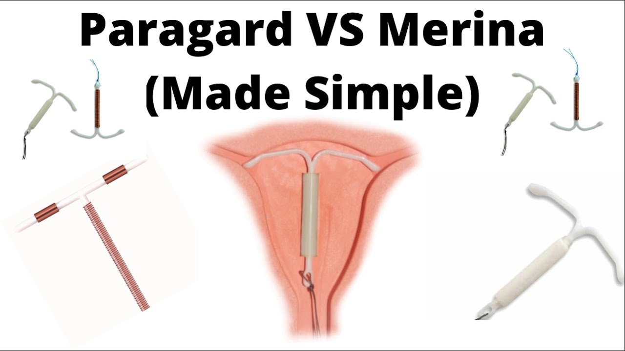 Противозачаточные имплантаты (Paragard против Mirena)
