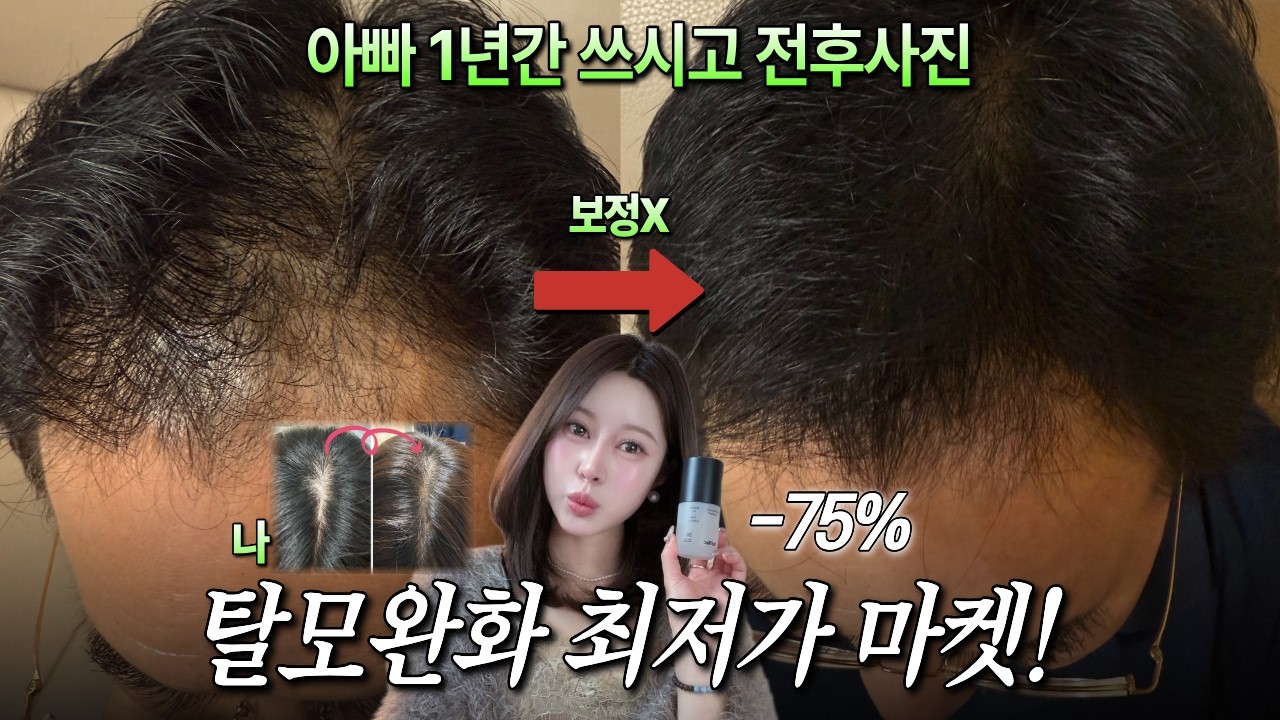 우리아빠 회춘템👍시술없이 이렇게나? 1년동안 쌓여온 온가족 찐후기(+문제성두피, 헤어라인, 견인성탈모)